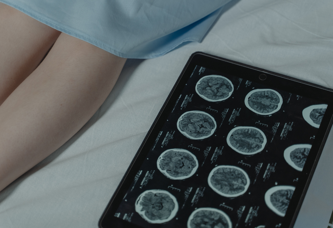 Nova terapia pode tratar tumores cerebrais pediátricos resistentes a tratamentos