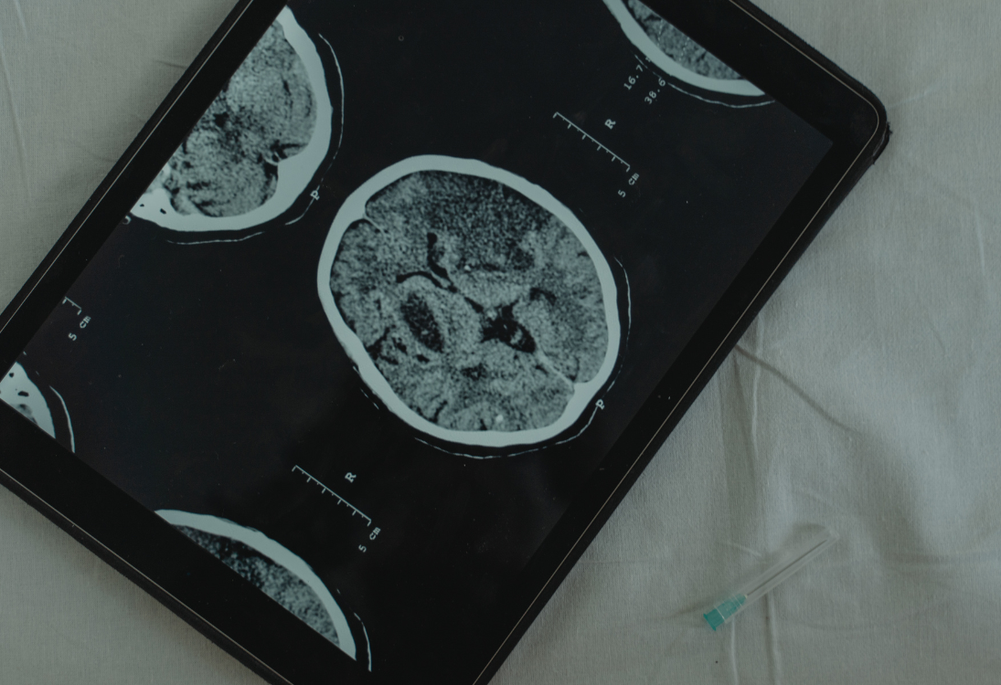 Nova estratégia mostra potencial para travar a progressão do meduloblastoma metastático