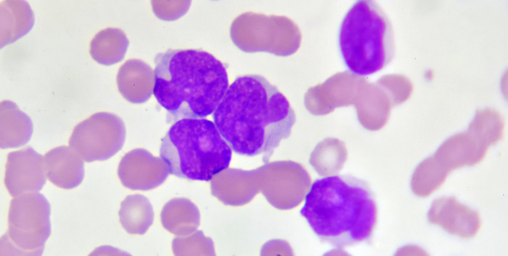 Leucemia mieloide crónica: Europa aprova medicamento para tratar crianças