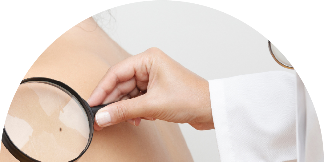 Melanoma pediátrico: um alerta crescente e desafios no diagnóstico
