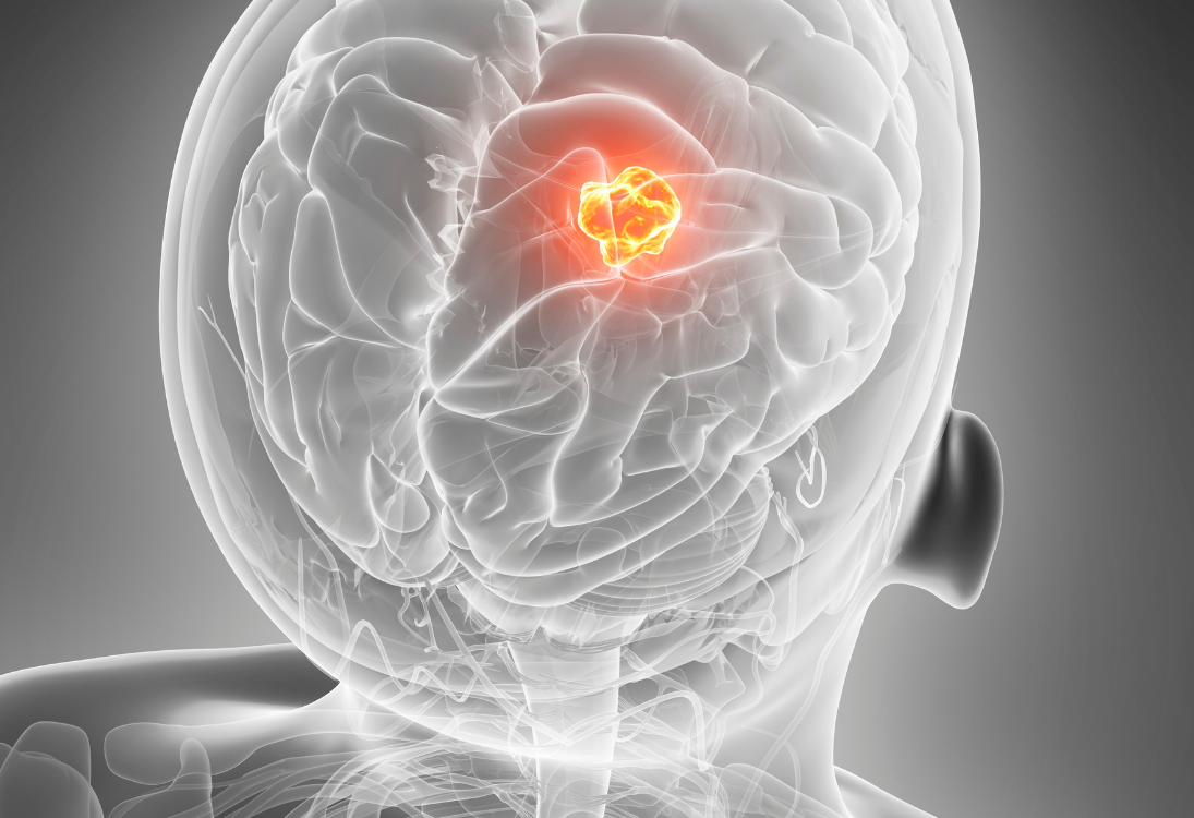 Estudo europeu traça pela primeira vez panorama realista da sobrevivência em tumores cerebrais pediátricos