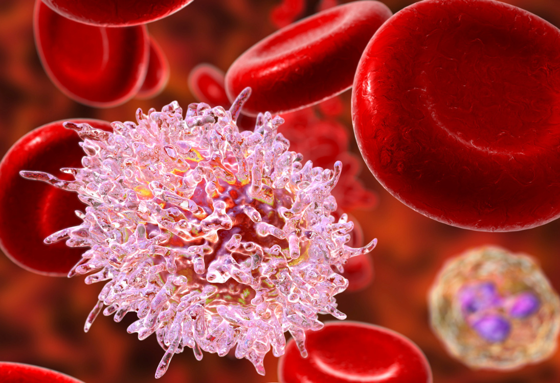 Leucemia pediátrica pode ser mais agressiva quando a mutação surge antes do nascimento