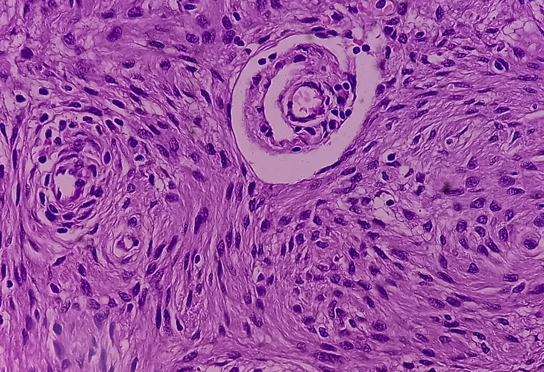 Sobreviventes de cancro pediátrico podem ter maior risco de meningiomas na idade adulta
