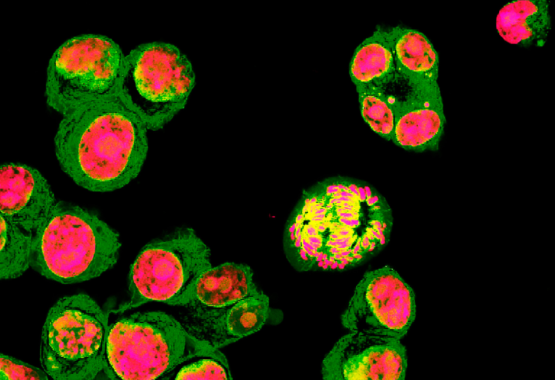 Estudo identifica novos alvos para travar o neuroblastoma de alto risco